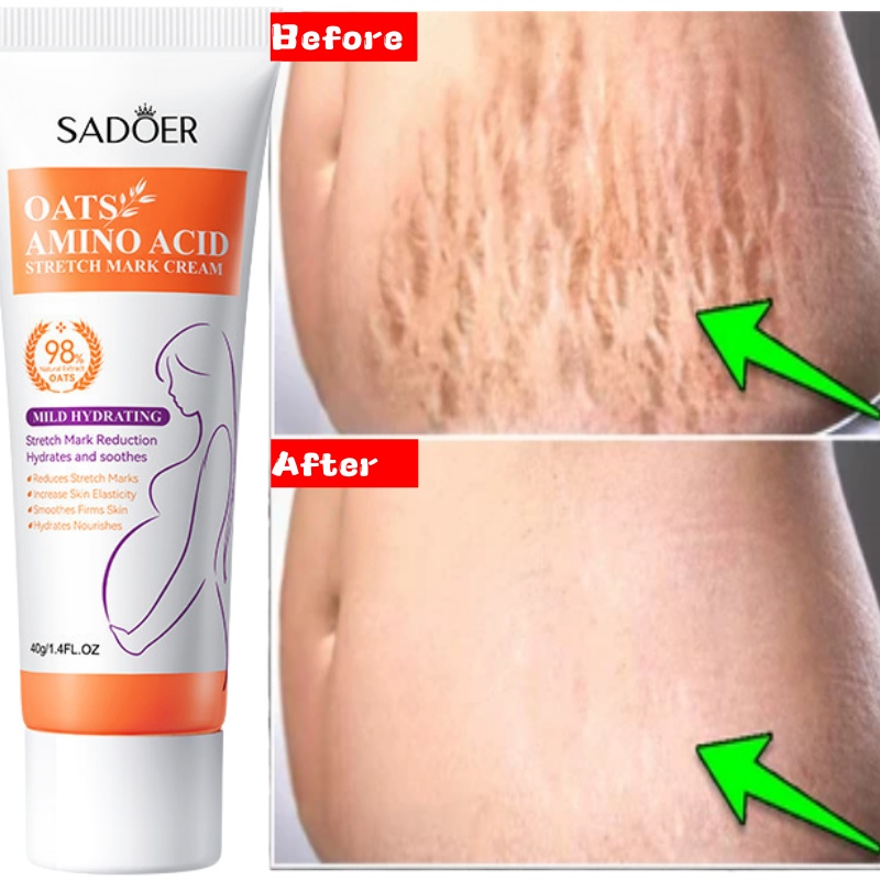 Skincare Oat - Crema de eliminación permanente de estrías,